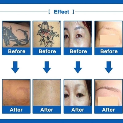 Retrait à commutation de Q de tache de rousseur de machine de retrait de tatouage de laser de ND Yag 110V/220V