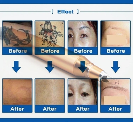 Laser blanc de ND Yag de couleur de tatouage de commutateur d'OEM Q de machine commerciale de retrait